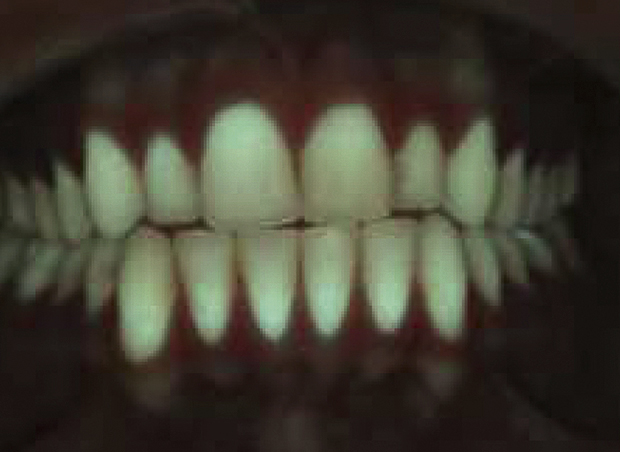 Rood-fluorescent tandplaquebeeld weinig plaqueophoping