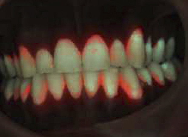 Rood-fluorescent tandplaquebeeld ernstige plaqueophoping