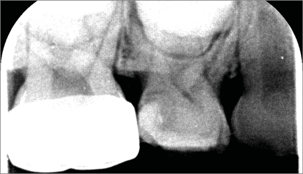 NRCT: tertiair dentine