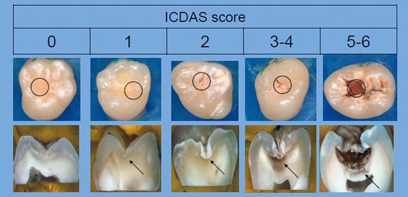 De ICDAS-score