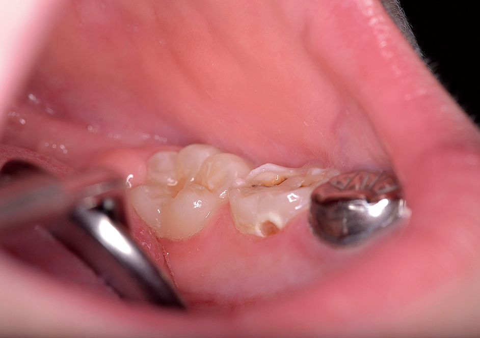 Gebitselement 75 met dentinecariës