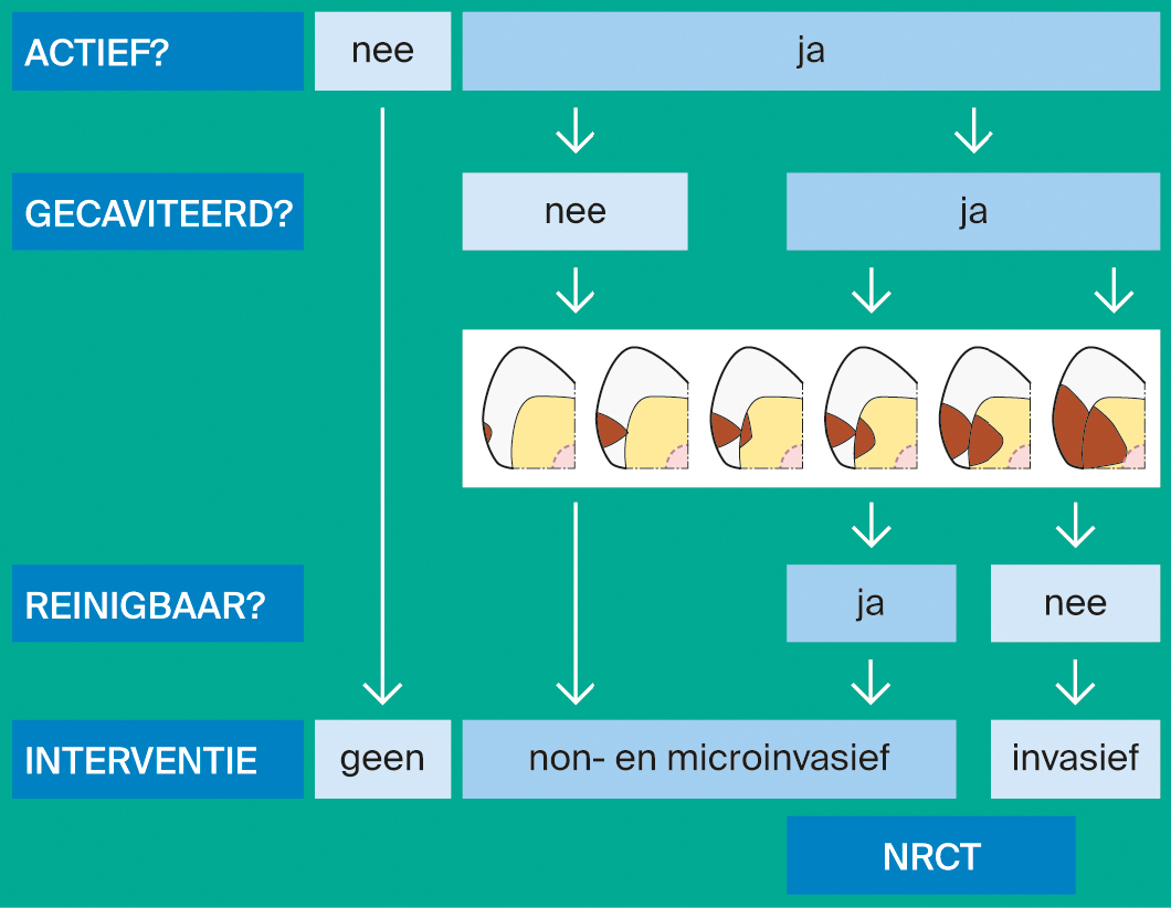 Stroomschema voor kiezen behandelmethode