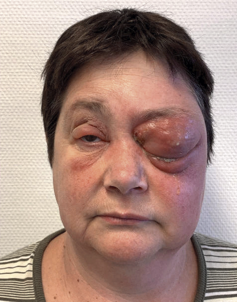 50-jarige vrouw met periorbitale zwelling en proptosis  (a)