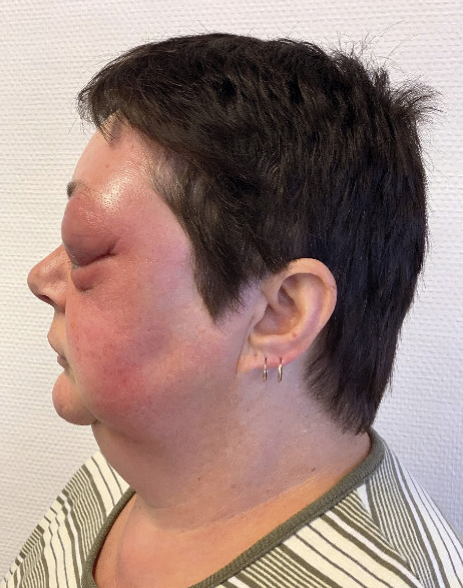 50-jarige vrouw met periorbitale zwelling en proptosis  (b)