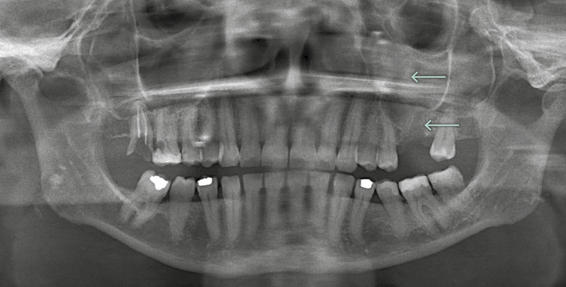PAN van patiënten met een dentogene infectie