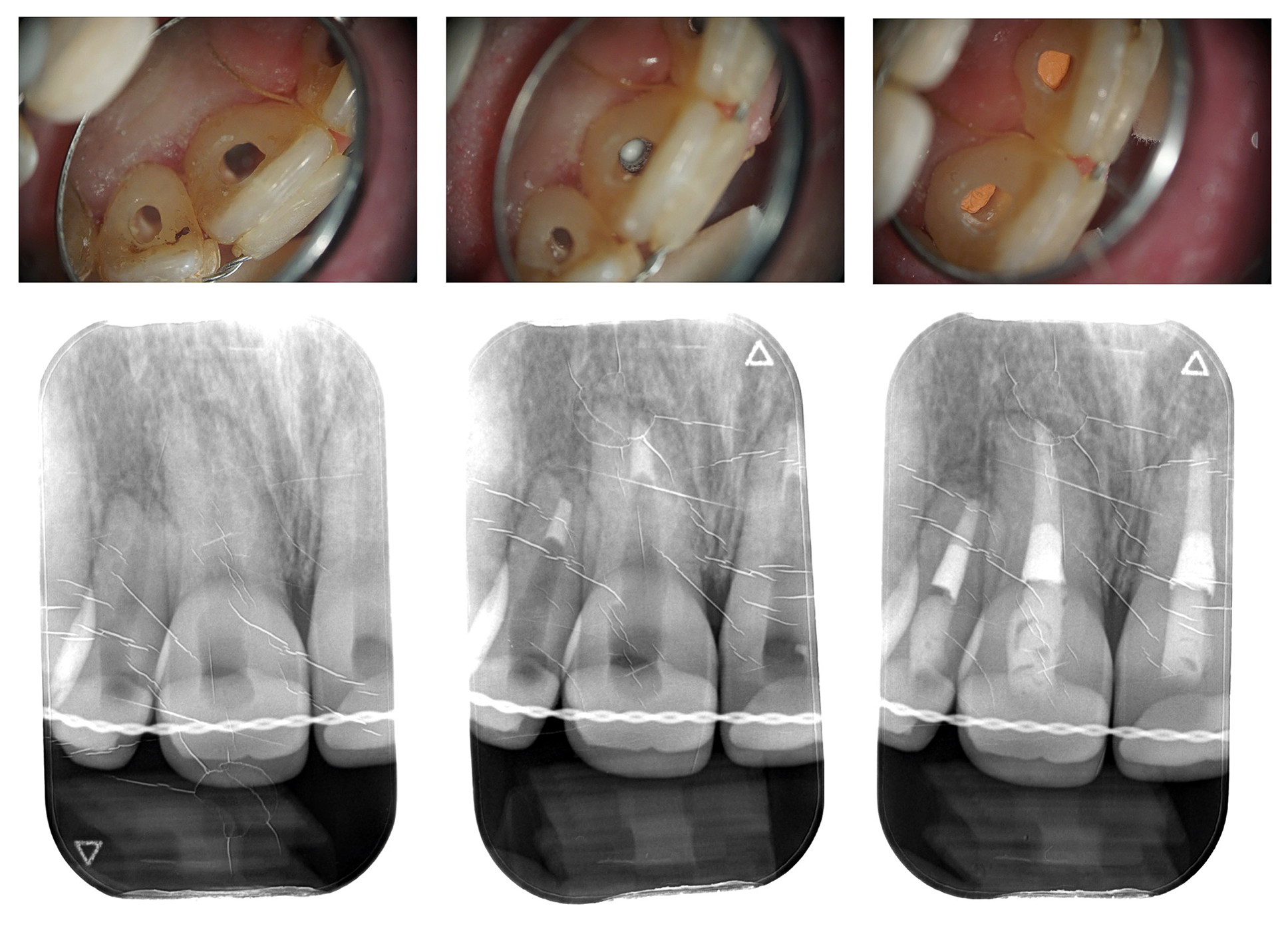 Endodontische behandeling getraumatiseerde gebitselementen
