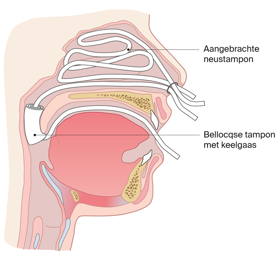 Bellocqse tamponade bloeding bovenkaak