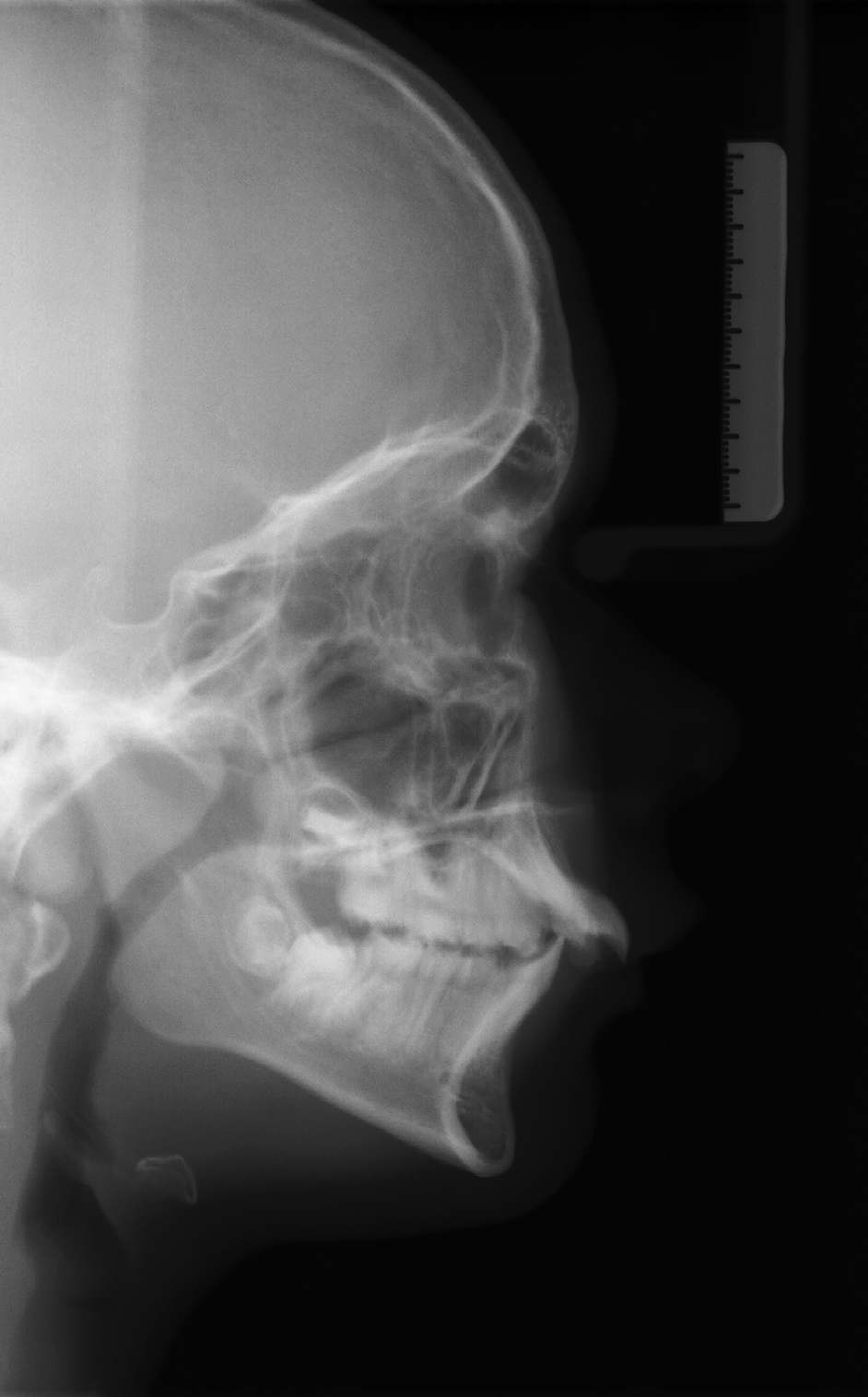 Laterale röngenschedelprofielopname amelogenesis imperfecta