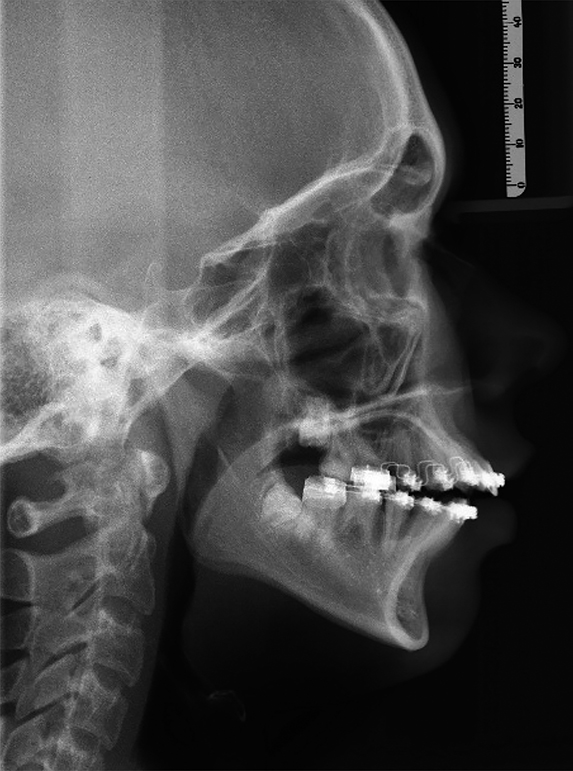 Retrognathie van mandibula bij amelogenesis imperfecta