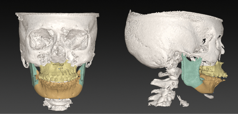 Digitale planning voor bimaxillaire osteotomie