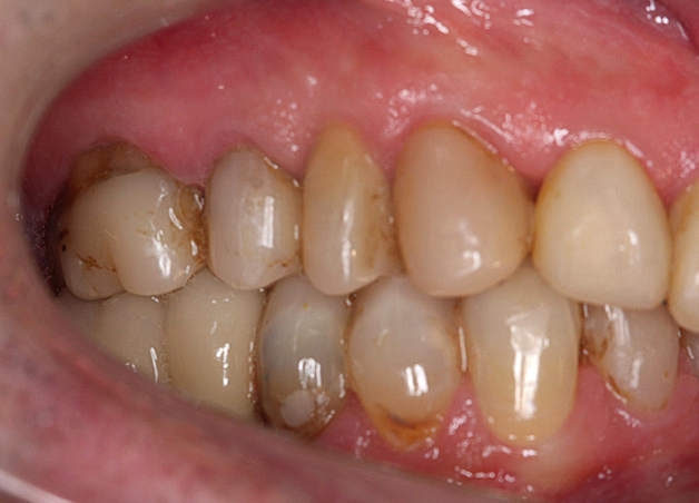 Behandelresultaat rechts na orthodontie