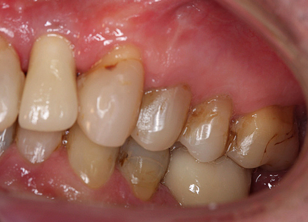 Behandelresultaat links na orthodontie