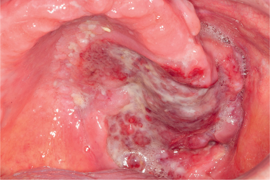 Ulcererende massa door non-Hodgkinlymfoom