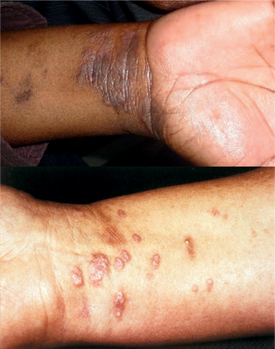 Cutane lichen planus