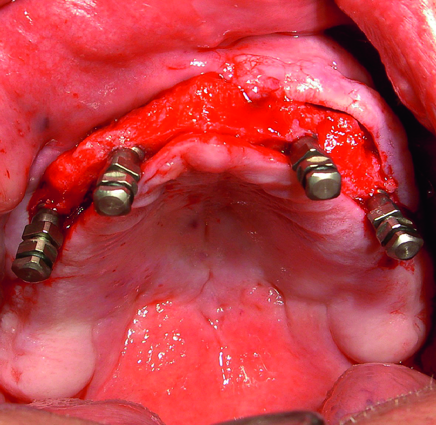 Peroperatief beeld direct na plaatsing implantaten