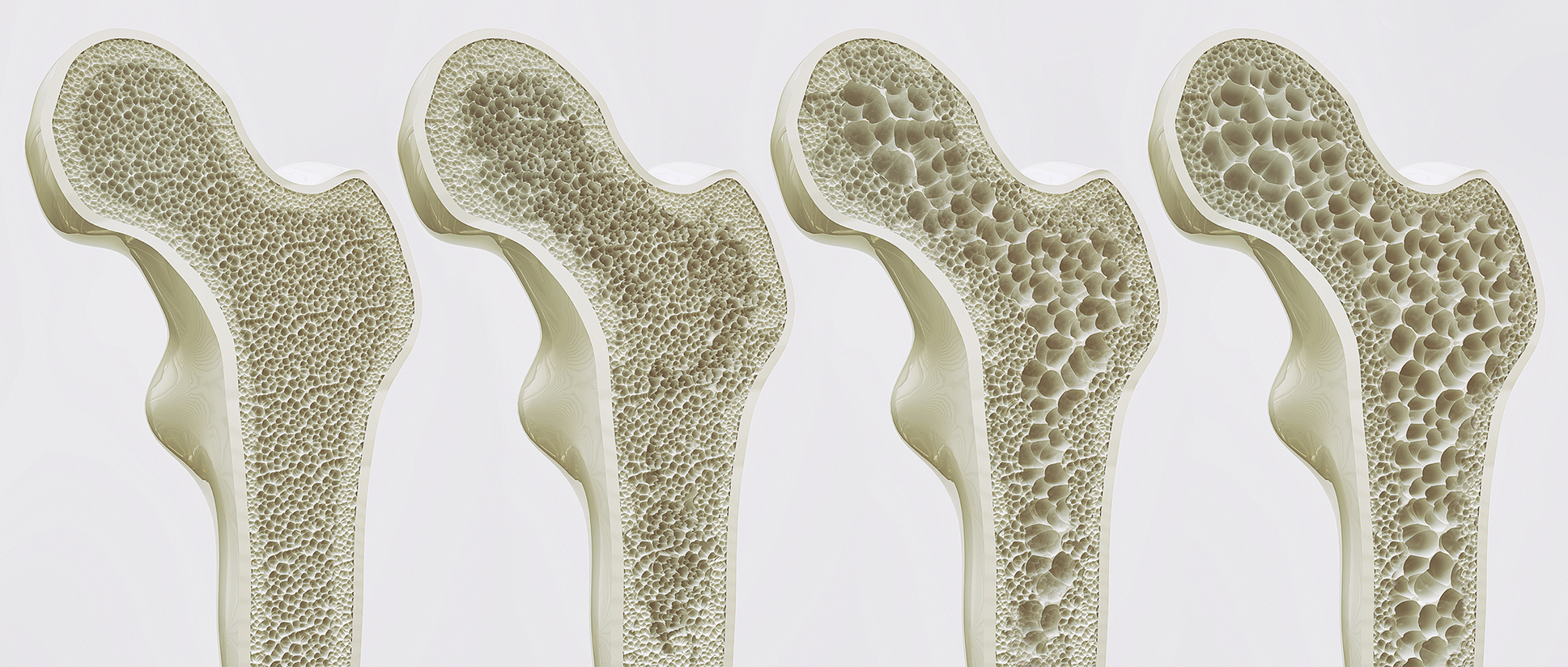 Osteoporose: risicofactor voor implantaten?
